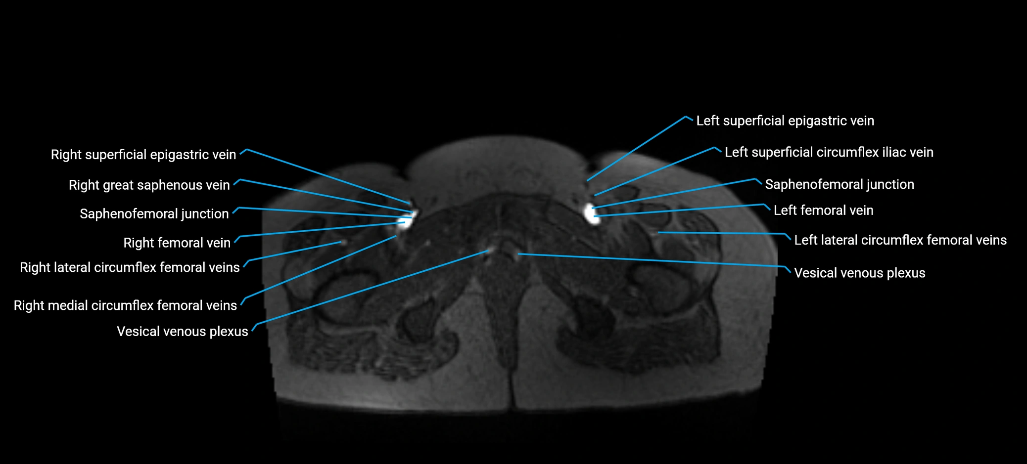 MRV abdomen pelvis & lower limb axial cross sectional anatomy labelled MRI image 194 (1).webp